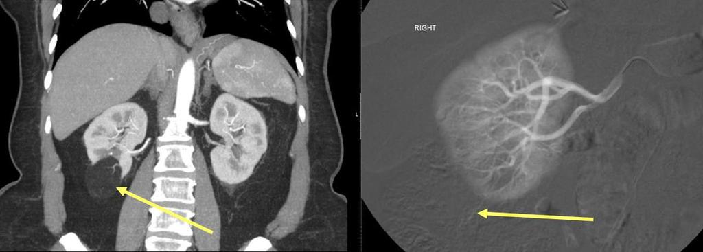 3: Grade 1: the angiomyolipoma in the lower pole of the right kidney in CECT