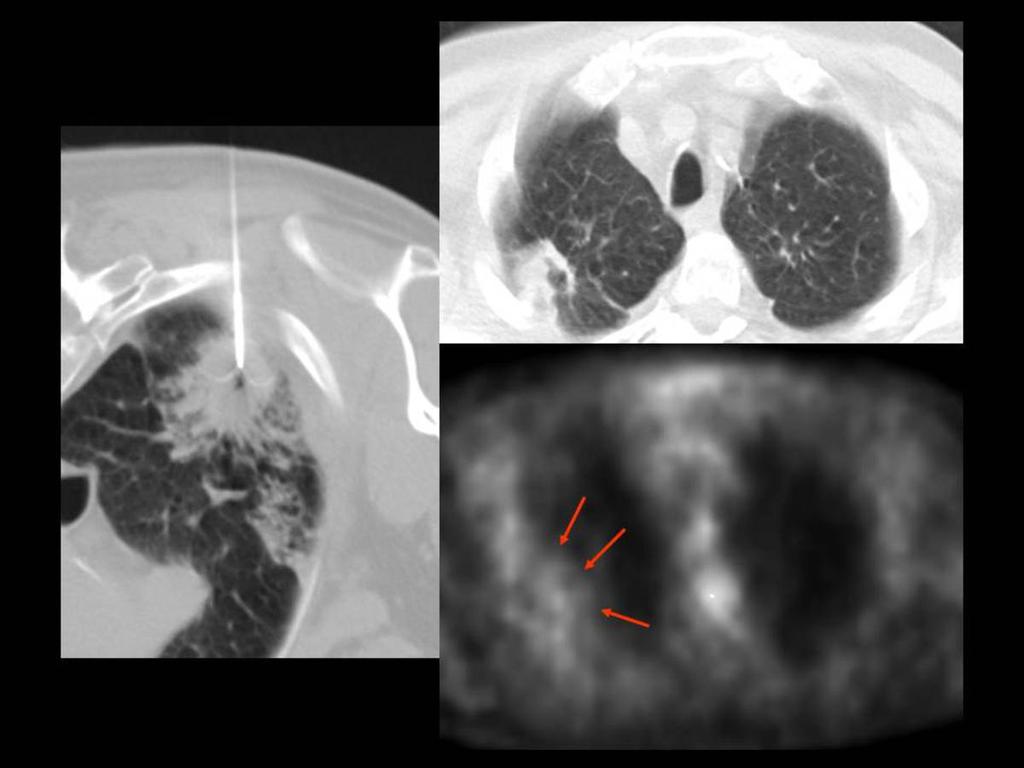 Fig. 2: Image shows the normal aspect of the ablated area 14 months after