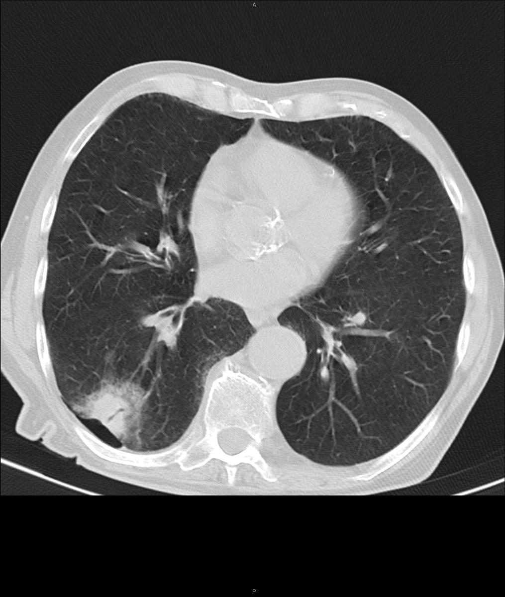 Fig. 2: CT scan obtained at the end of the RFA shows a small located pneumothorax and a