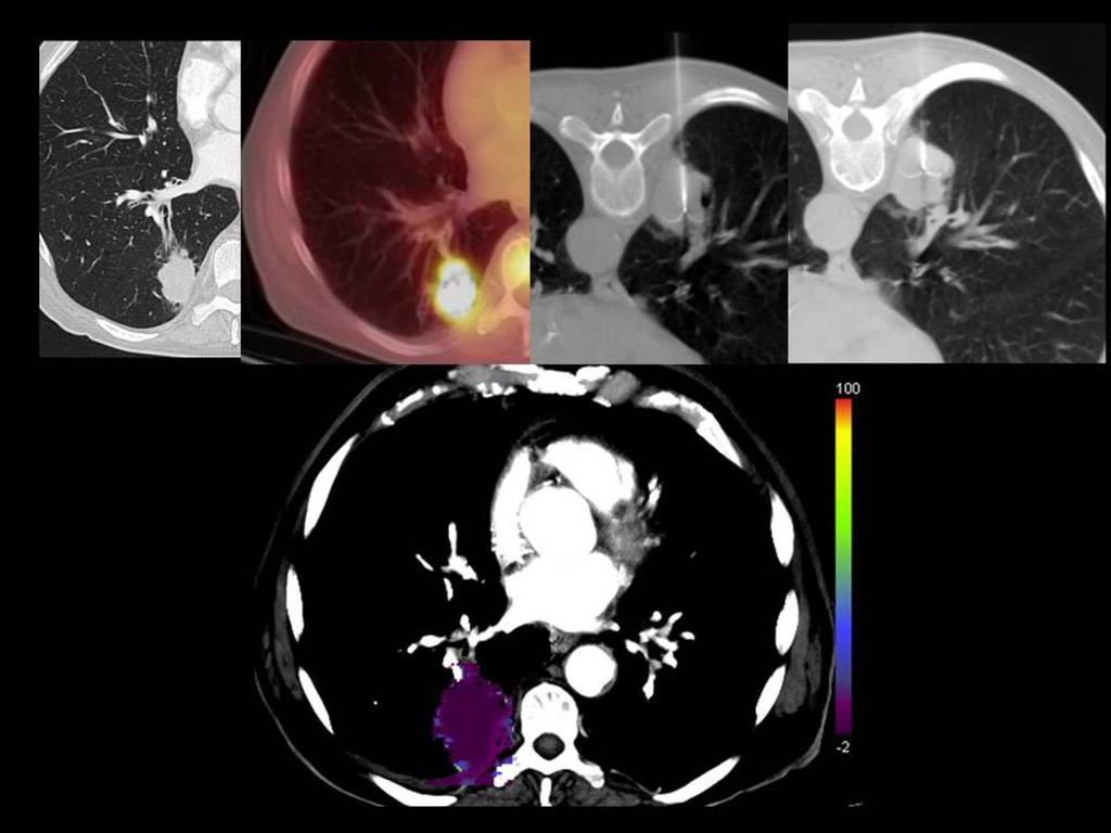 Fig. 3: CT perfusion obtained 24 hours after the RFA.
