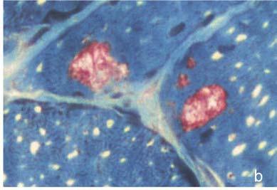 Desmin-associated myopathy: skeletal muscle findings Rimmed myocyte