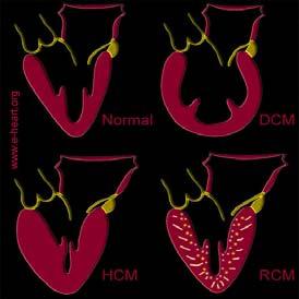 Forms of cardiomyopathy Normal Dilated Hypertrophic Restrictive Restrictive