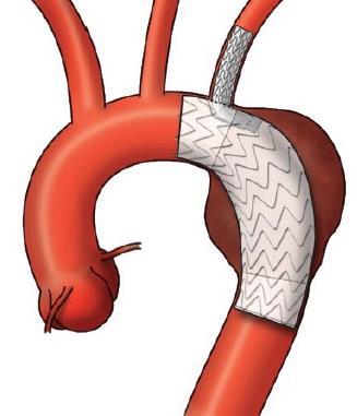 Gore TBE Procedural steps Step 1: - Catheterization of ascending aorta and branch vessel from below Step 2: - Introduction of aortic main body over