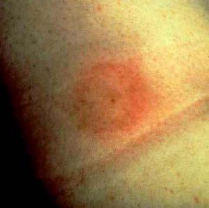 Lyme Disease: Clinical Manifestations Early localized stage: o Erythema migrans (70 80%) o Constitutional symptoms Early disseminated stage: o Erythema migrans o