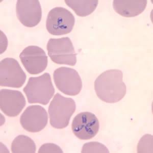 Babesiosis Diagnosis o Blood smear (tetrad Maltese-cross) o Babesia DNA by PCR Treatment o Patients without clinical manifestations do not require treatment unless they have had parasitemia for >3