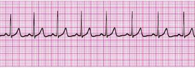 27. Effective bag-mask ventilations are present in a patient in cardiac arrest. Now, 2 minutes after epinephrine 1 mg IV is given, PEA continues at 30 bpm.