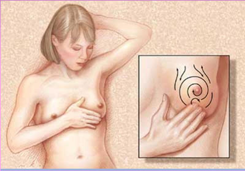 Detection of Breast Cancer Asymptomatic Lump Dimple