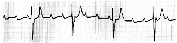 Second-Degree AV Block Mobitz II P P QRS Regularly dropped ventricular beats - 2:1 block (2 P waves to 1 QRS complex) - Ventricular rate = 60 bpm - Atrial rate =