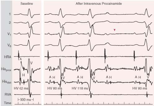 Finding at EPS Bifascicular Block Right