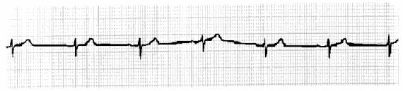 Sinus Node Dysfunction Sinus Bradycardia Persistent slow rate from the SA node. The parameters from this waveform include: - Rate = 45 bpm - PR interval = 180 ms (.