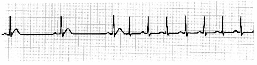 Sinus Node Dysfunction SA Exit Block 2.1-second pause Transient blockage of impulses from the SA node - Rate = 52 bpm - PR interval = 180 ms (.18 seconds) - 2.