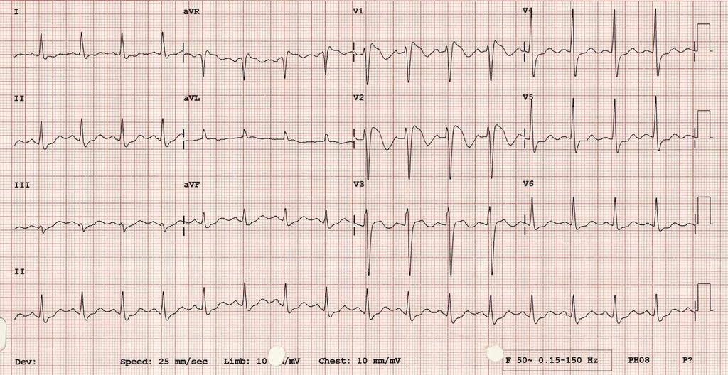 28 M BG: FHx of young cardiac arrest