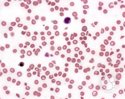 Anemia High LDH Sickle Cell Disease Sickle Cells Polychromatophilic