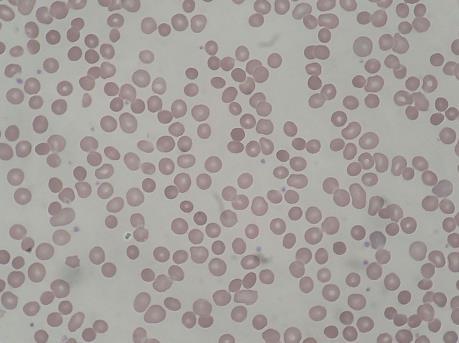 This smear demonstrates: Rouleaux Formation Note the obvious finding here. Answer: B Multiple Myeloma Question 2 Question 2 A 24 year old female presents with fatigue and early satiety.