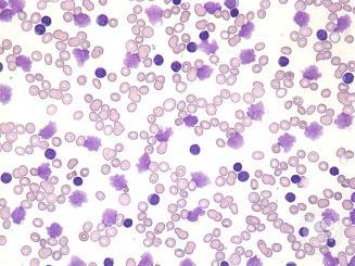 WBC Abnormalities - Leukocytosis Question 3 Note increased mature lymphocytes (same size as erythrocytes) Smudge Cells Elev WBC Predominantly lymphocytes CLL You are called to consult for a patient