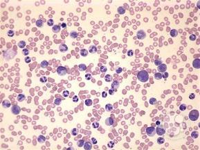 WBC 179,000 Hgb 10.1 Platelets 450 Chemistry wnl Question 3 Which of the following is correct? a) This is a leukemoid reaction and she should be evaluated for an underlying infection.