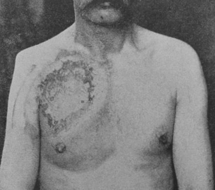 Early Radiation Injury 1898 Photograph shows severe chest burn on a United States