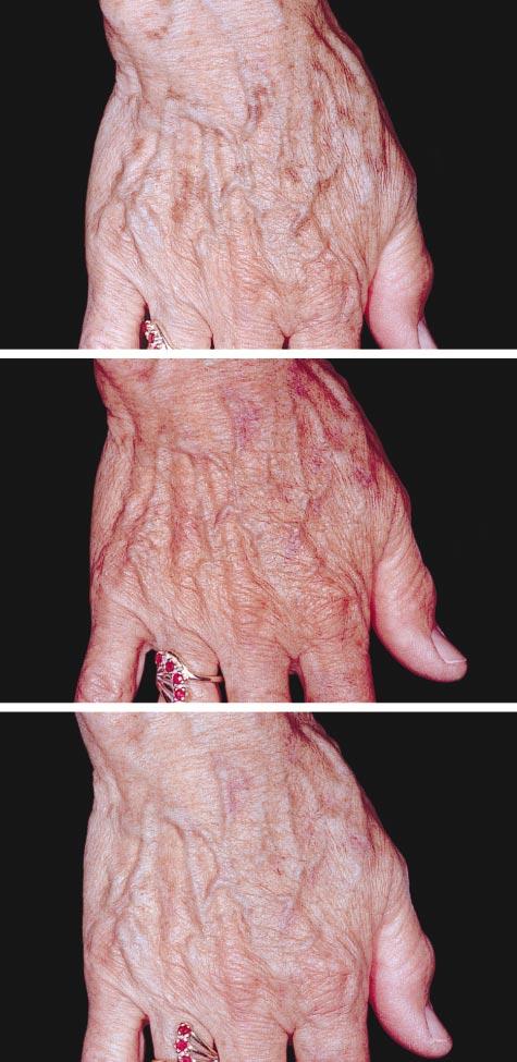 RESULTS A B C Figure 1. Right hand of a 67-year-old woman preoperatively (A) and 6 weeks (B) and 12 weeks (C) following treatment.