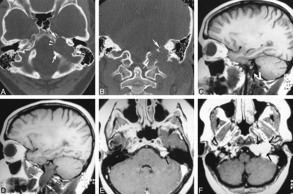 1142 ELDEVIK AJNR: 21, June/July 2000 FIG 2. Case 2: 21-year-old woman with otalgia and sudden seventh cranial nerve paralysis.