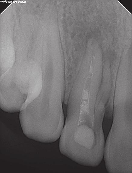 Lee MH et al. radiolucent area was noticed at the apices of roots of the maxillary right lateral incisor (Figure 1a).