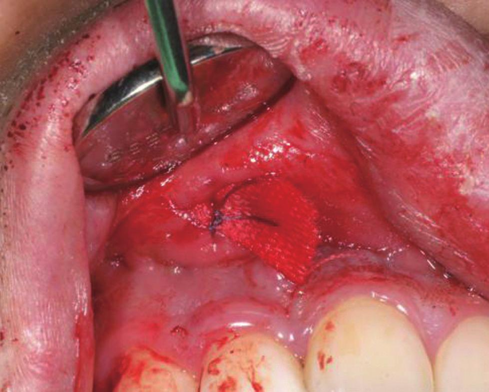 The pulpal diagnosis was previous endodontic treatment and the periapical diagnosis was chronic apical abscess with sinus. There appeared to be two roots that had distinct root canal space.