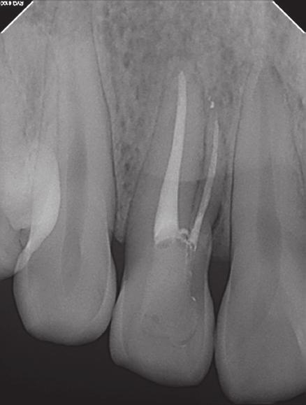 The second canal was located at the corresponding part of palatogingival groove in the pulpal chamber of the tooth.