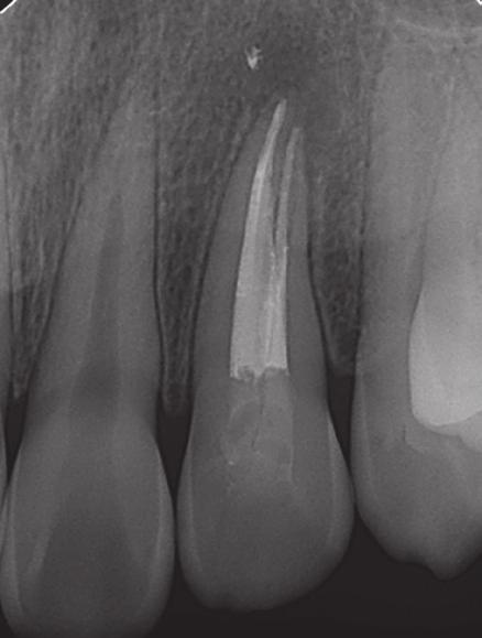 (a) Preoperative periapical radiograph; (b) Working length files of the first, second and