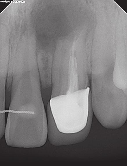 Black arrow indicates the fourth canal; (d) Intraoral photograph of access cavity and