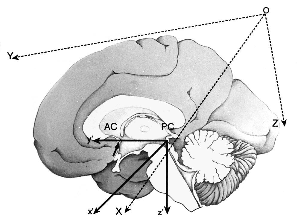 AJNR: 18, June 1997 THALAMIC STIMULATION 1095 Fig 1. Schematic drawing of the two coordinate systems.