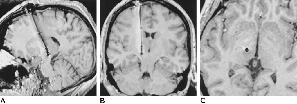 AJNR: 18, June 1997 THALAMIC STIMULATION 1101 Fig 11. Same patient as in other figures. Control SPGR acquisitions (25/5/1, 25 flip angle) show the quadripolar electrode after implantation.