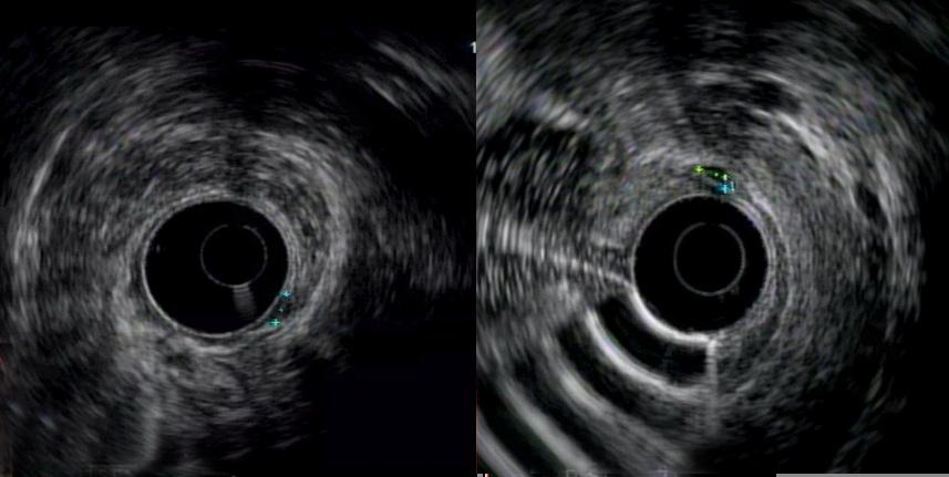 Chablaney S et al. Diagnosis and Management of Rectal NETs A Fig. 2. Radial endosonographic findings of rectal neuroendocrine tumors.