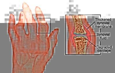 Rheumatoid Arthritis A chronic Inflammatory Condition Joints Extra-articular involvement Global prevalence ~ 0.