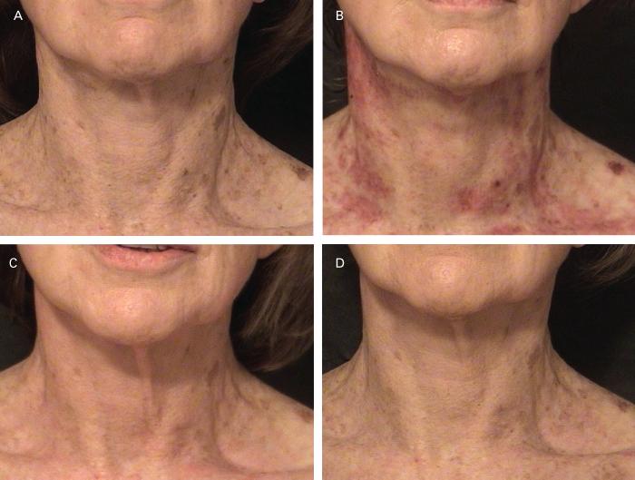 ALSTER AND KONDA Figure 3. Photodamaged neck skin before (A) and 4 days (B), 14 days (C), and 90 days (D) after PSR treatment. (A and B) Wrinkle grade, 5; pigment grade, 2.
