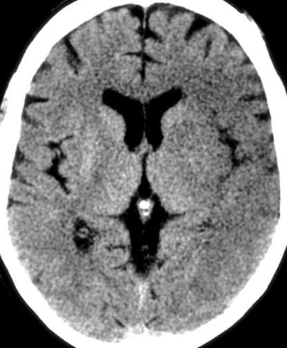 Ischemic Injury on CT Subtle decreased attenuation of grey matter loss of grey - white differentiation loss of cortical ribbon