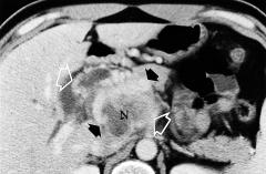 Three out of six (50%) tumors were considered as malignant on the basis of CT appearances, with the presence of regional lymph node involvement (n=3) and portal vein encasement (n=1).