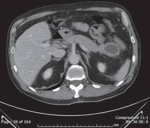 gstro cystic tumors of the pncres 14 Lymphoepithelil cysts my occur in ny portion of the pncres nd re usully (ut not lwys) peripncretic s opposed to intrpncretic [see Figure 16].