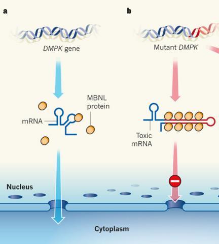 Is pathology the result of an RNA gain-of-function mechanism RNA gain-of-function- myotonic dystrophy type 1 CUG (DM1) accumulate in nuclear RNA aggregates that sequester the Muscleblind-like (MBNL)