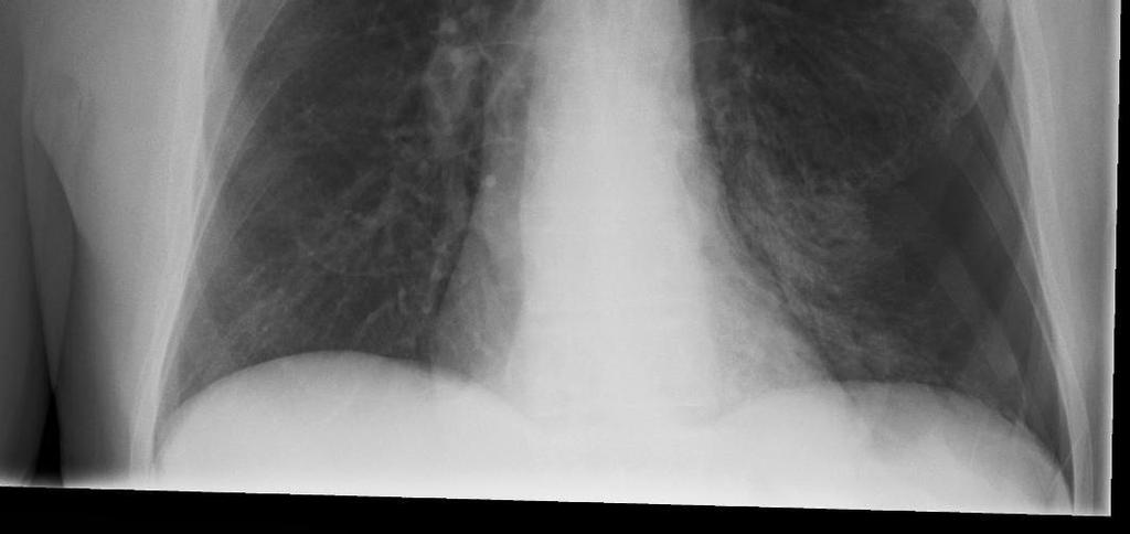 pneumothorax if tension manage with