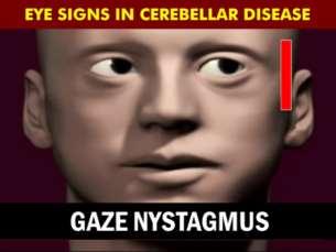 The eye signs of Cerebellar disorder :- Gaze evoked nystagmus in any direction Jerky / Saccadic smooth tracking Down-beating nystagmus (DBN) Rebound nystagmus Dysmetria :- hyper/hypo metria in
