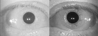 :- hyper/hypo metria in saccade test Periodic Alternating Nystagmus (PAN) Central