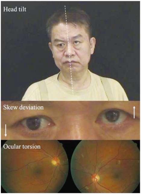 disorder consisting of: skew deviation binocular eye torsion. head tilt.