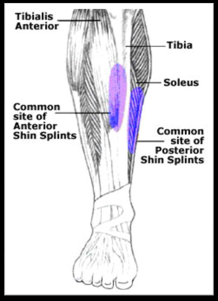 Shin Splints Misleading terminology: Most commonly associated with medial tibial stress syndrome Associate