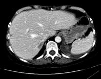 8cm liver lesion which on retrospect review may have been faintly present on preoperative imaging Molecular profiling