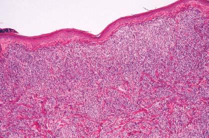 CASE REPORT A 35-year-old male had a 6-month history of erythematous skin lesions over the face and trunk without pruritic or painful sensation.