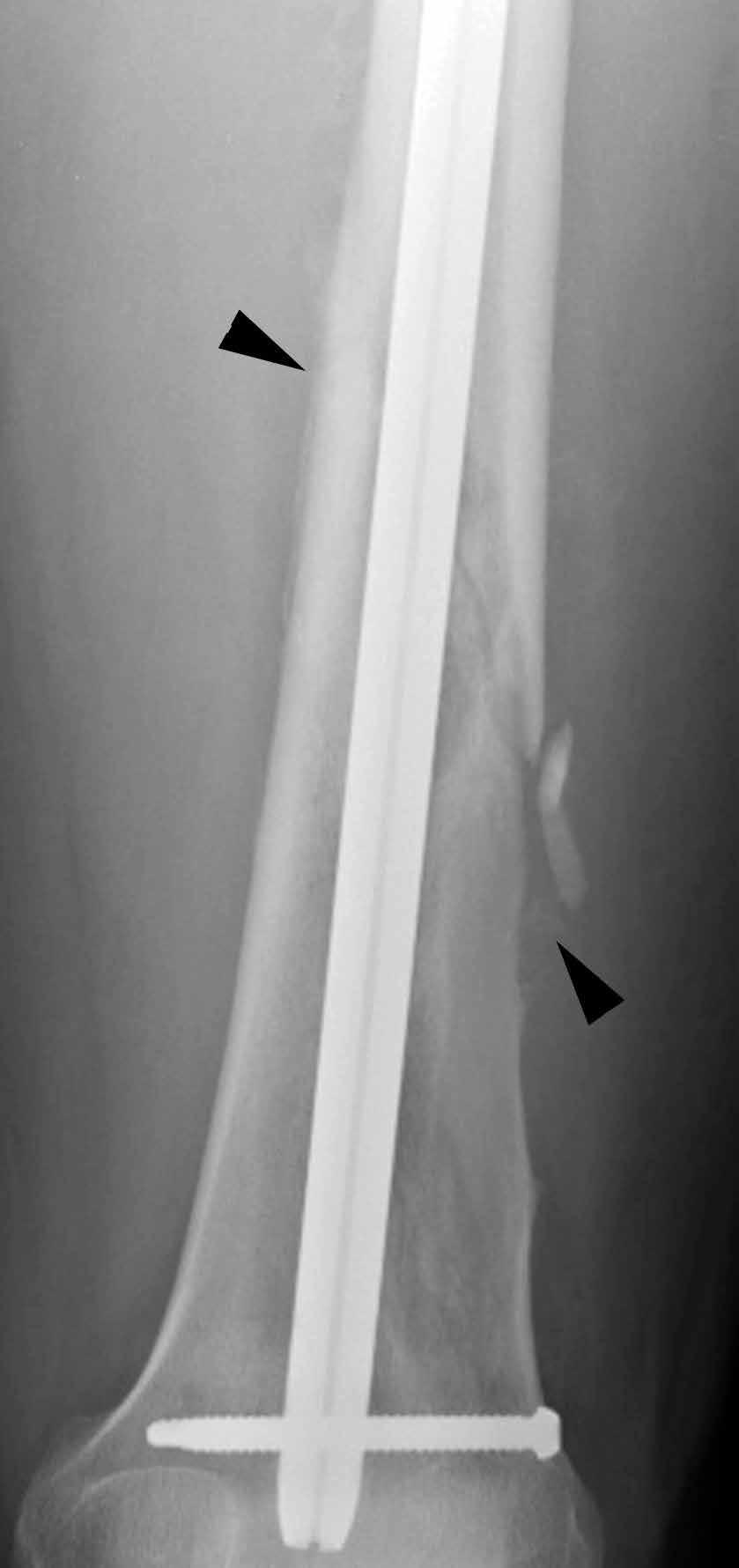 Malignant Transformation of an neurysmal one Cyst to Fibroblastic Osteosarcoma Figure 2. () nteroposterior and () lateral radiographs 1 month after presentation.