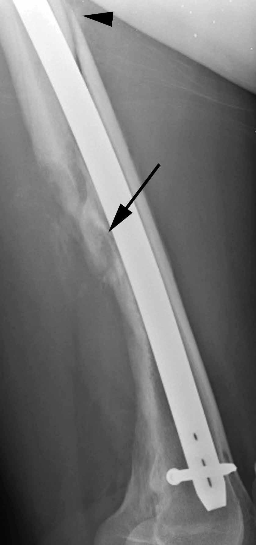 () nteroposterior and () lateral radiographs 2 years after presentation show complex bony destructive changes (black arrowheads) with irregular sunburst pattern of periosteal reaction (white arrows)