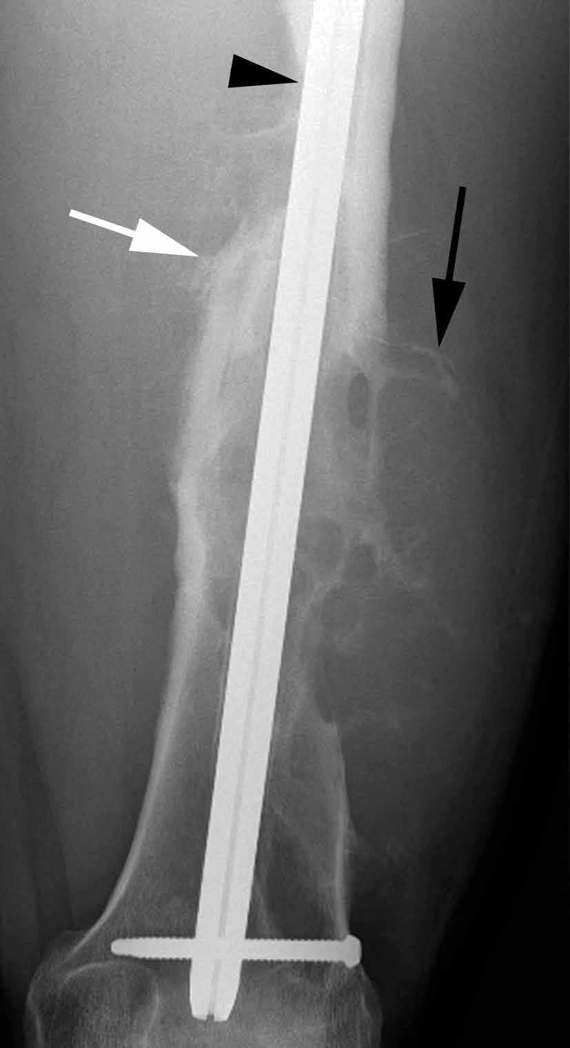 before antegrade intramedullary interlocked rod fixation. The histologic specimen was reported by the referring pathologist as being consistent with a unicameral bone cyst with hemorrhage.