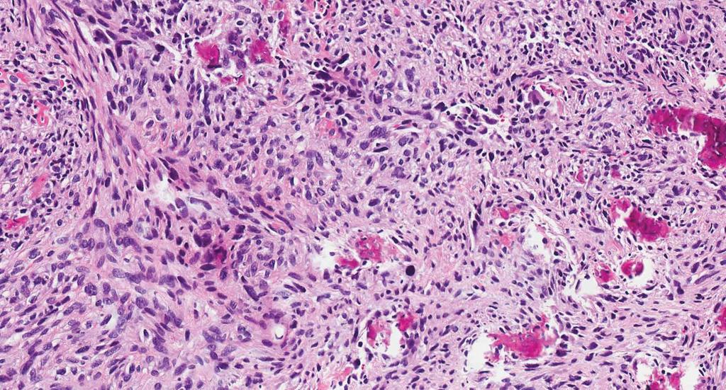 formation by malignant cells (hematoxylin-eosin, original magnification 200). () Strongly positive expression of MDM2 (immunohistochemical staining, original magnification 400). Figure 7.
