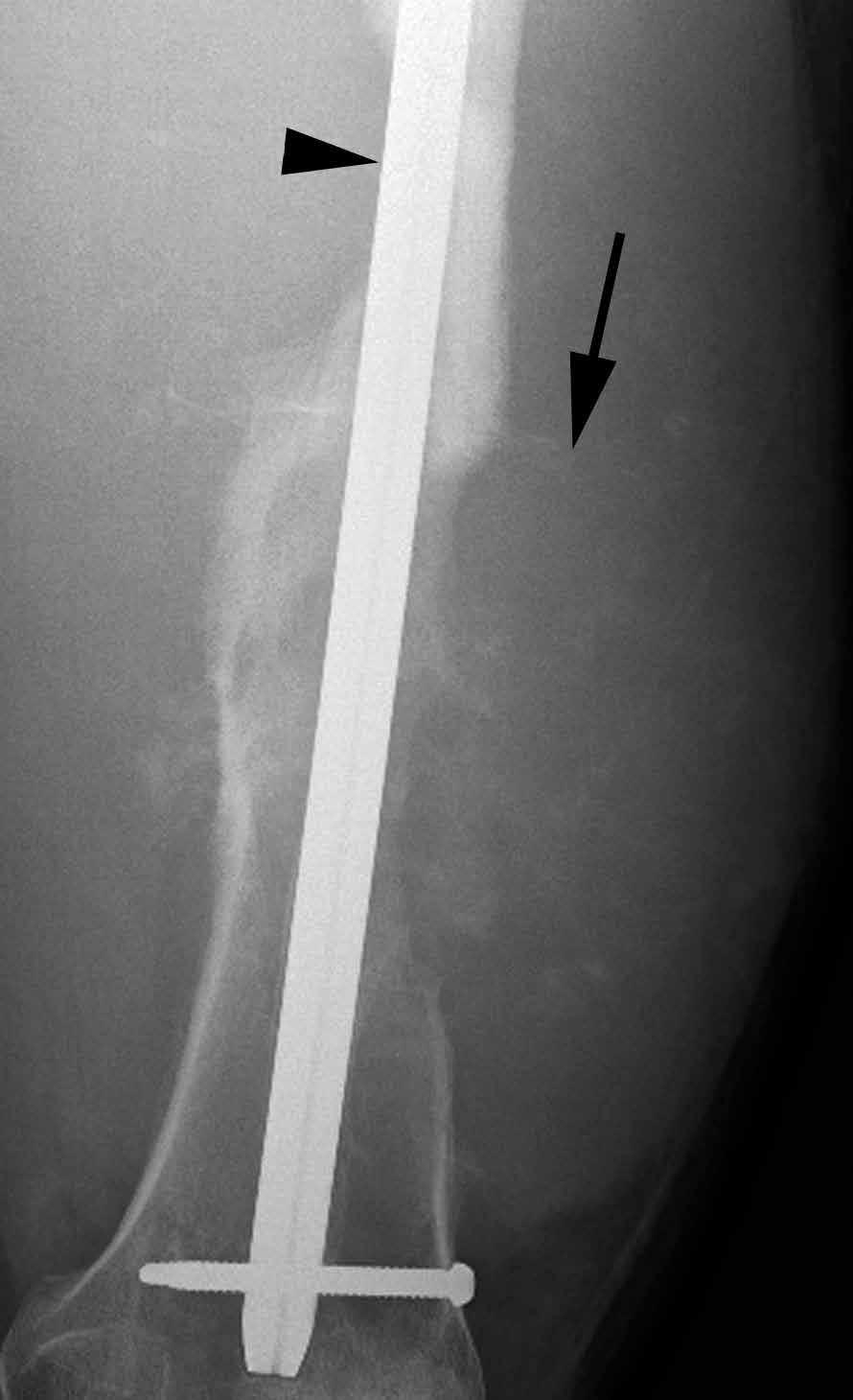 enlargement of soft-tissue mass (arrows), again concerning for a highly aggressive, rapidly progressive osteosarcoma.