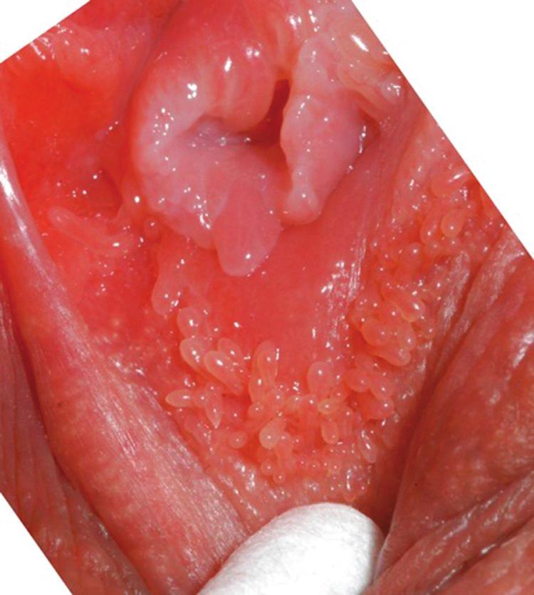 IFCPC Vulva Terminology & 5 Fig 1 4/C Figure 1. Labial micropapillomatosis, a normal finding. IFCPC believe that there is a use for the colposcope in vulvar examination.
